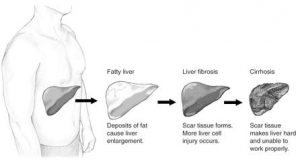 Fatty liver: deposits of fat cause liver enlargement; Liver fibrosis: scar tissue forms. More liver cell injury occurs; Cirrhosis: scar tissue makes liver hard and unable to work properly.